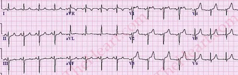 IRaFB on EKG
